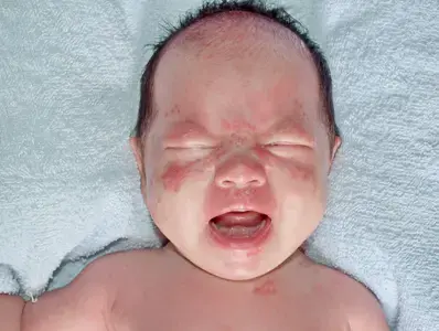 An Infant With Rash